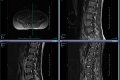 3 herniated discs look like this